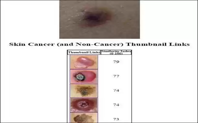 Skin Cancer Image Search from Chrome web store to be run with OffiDocs Chromium online Skin Cancer Image Search from Chrome web store to be run with OffiDocs Chromium online
